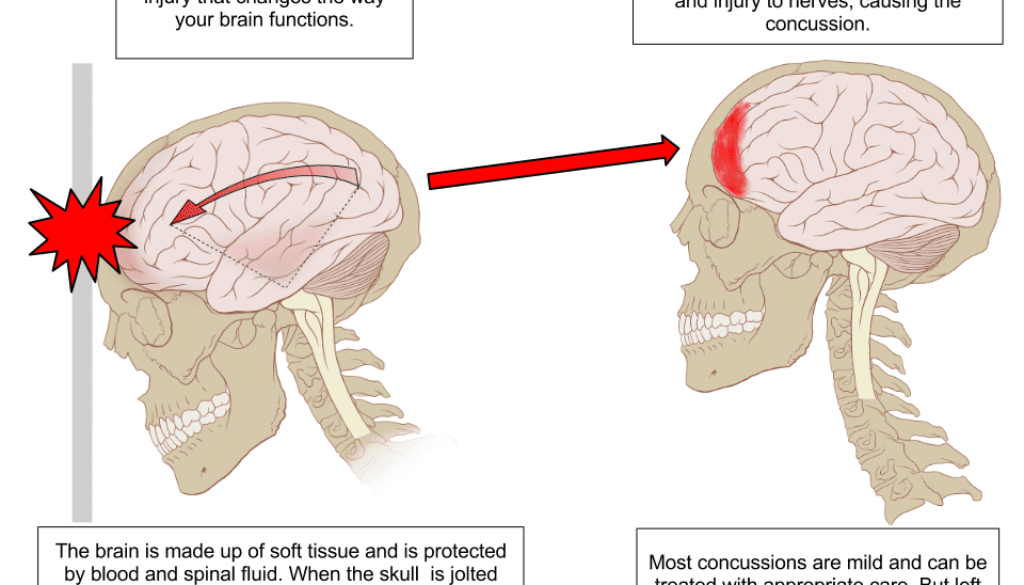Concussion Anatomy
