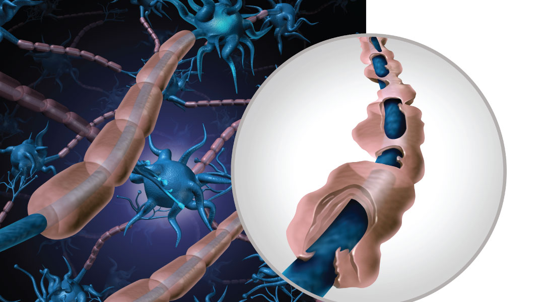 Post Covid-19 and Covid-19 Vaccine Neurological Issues - Brent